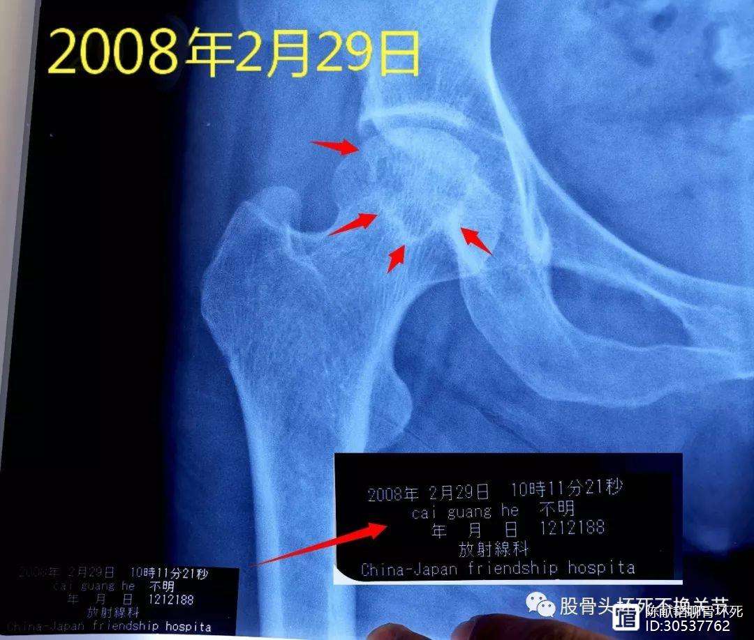 唐山人工骨头医保报销多少(人工骨头医保报销多少比例)